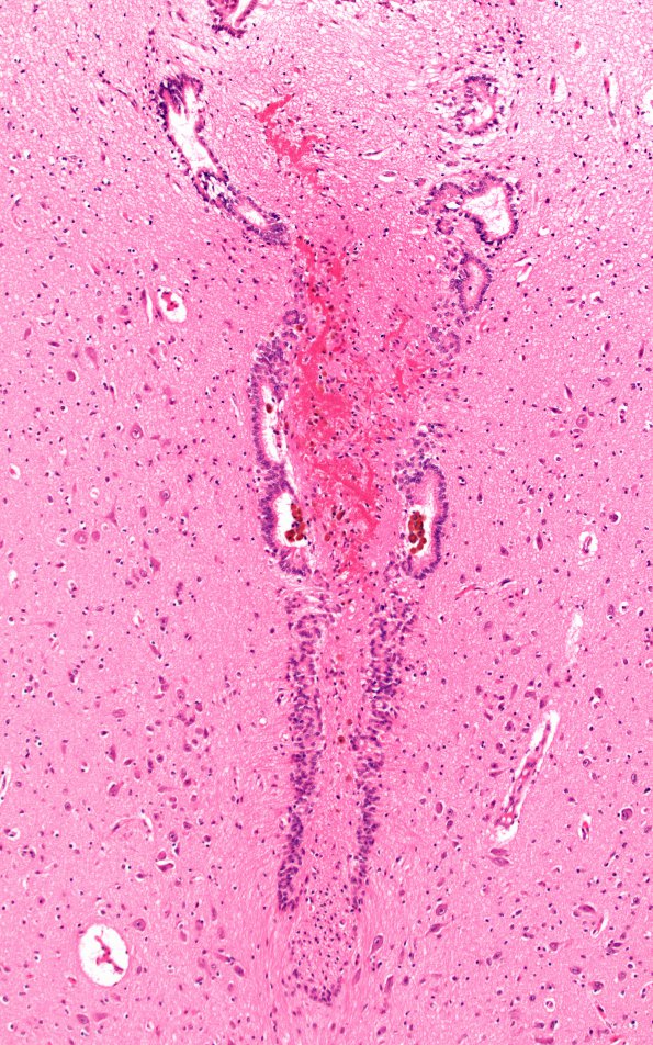 7D3 Hydrocephalus after IVH (Case 7) N6 10X 1