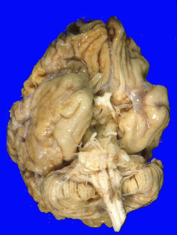 1A1 Hypoxia-Ischemia, SP Drug OD,  (Case 1) H&E 1