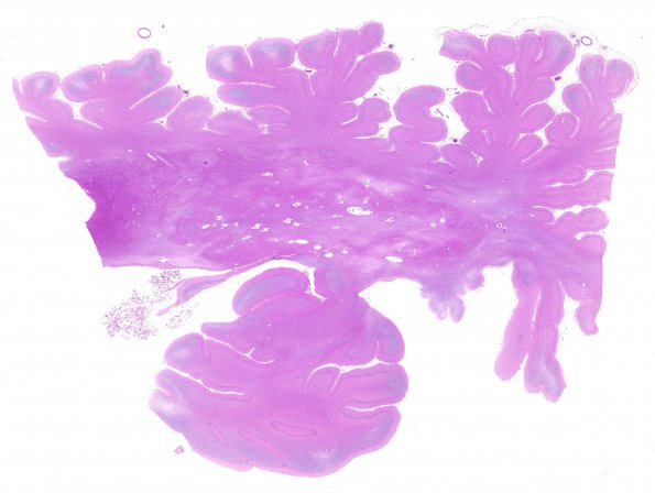 1B1 Hypoxia-Ischemia, SP Drug OD (Case 1) H&E N9 WM