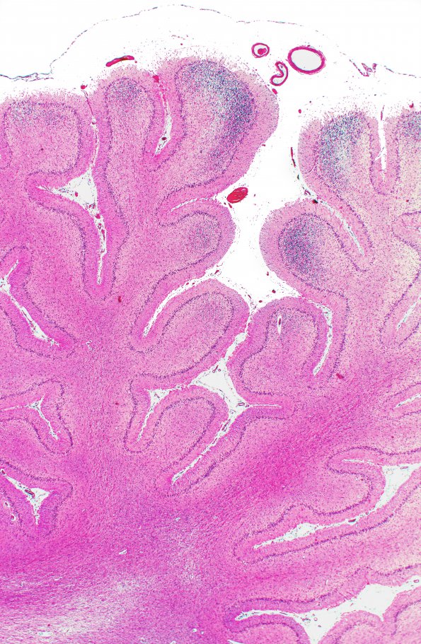 1B2 Hypoxia Ischemia (Persist Veg State, Case 1) N9 2X