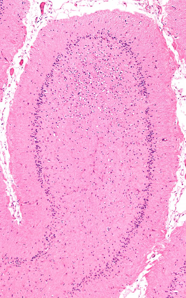 1B3 Hypoxia Ischemia (Persist Veg State, Case 1) N9 10X