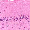 1B4 Hypoxia Ischemia (Persist Veg State, Case 1) N9 40X