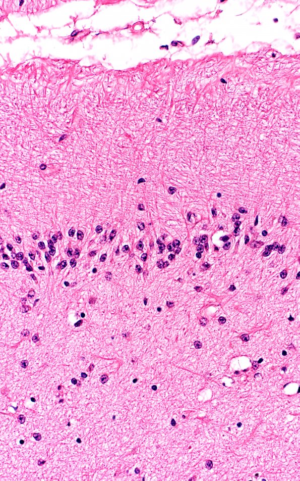 1B4 Hypoxia Ischemia (Persist Veg State, Case 1) N9 40X