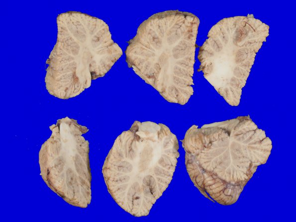 2A Hypoxia Ischemia (Case 2)