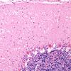 2B1 Hypoxia-ischemia (Case 2) H&E 2