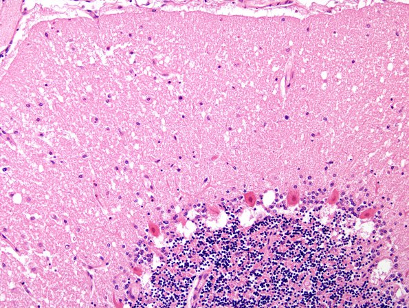 2B1 Hypoxia-ischemia (Case 2) H&E 2