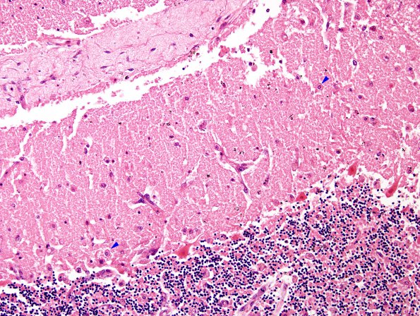 2B2 Hypoxia-ischemia (Case 2) H&E 1 copy