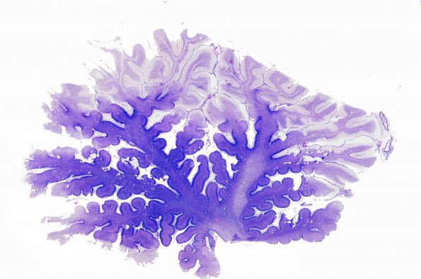 3D1 (Case 3) Holtzer stain