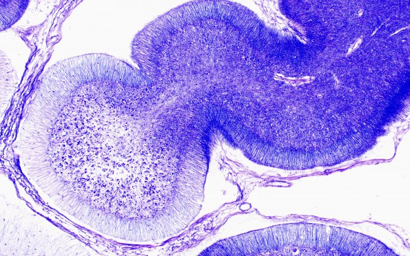 3D3 (Case 3) Holtzer stain 10X