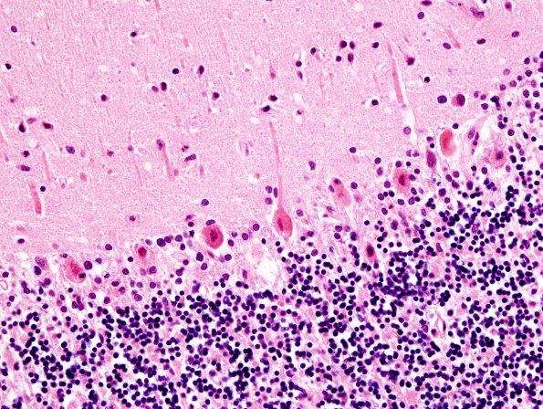 4A Hypoxia-Ischemia Adult (Case 4) Purkinje H&E 1