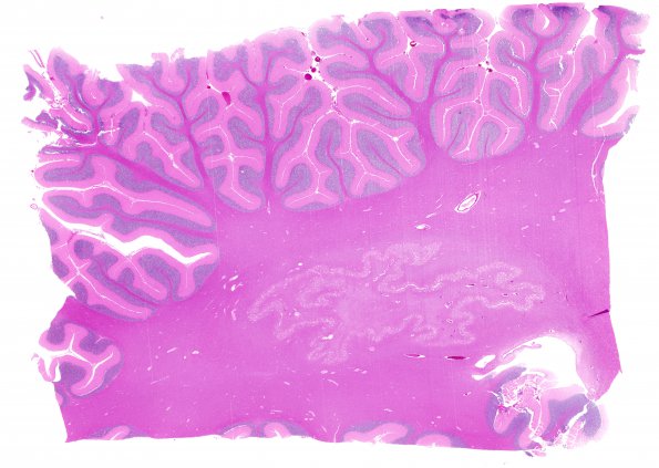 5A1 Hypoxia-Ischemia, Adult (Case 5) H&E N9 WM