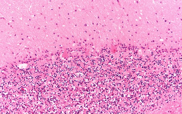 5A2 Hypoxia-Ischemia, Adult (Case 5) H&E N9 20X