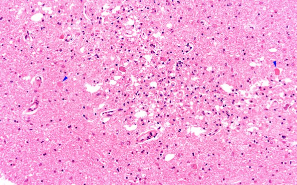 5A4 Hypoxia-Ischemia, Adult (Case 5) H&E N9 dentate 20X