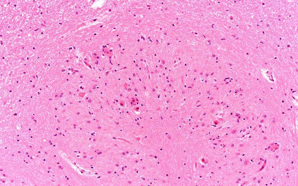 5A5 Hypoxia-Ischemia, Adult (Case 5) H&E N12 20X