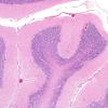 6A1 Hypoxia-Ischemia (Case 6) H&E 7A