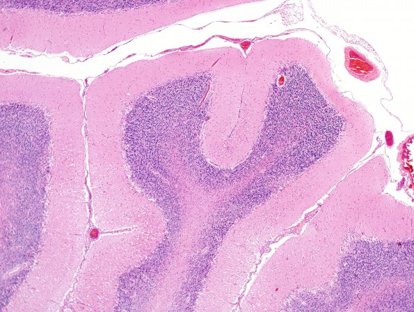 6A1 Hypoxia-Ischemia (Case 6) H&E 7A