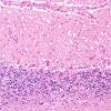 6A3 Hypoxia-Ischemia (Case 6) H&E 10