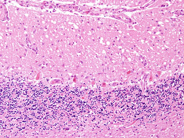 6A3 Hypoxia-Ischemia (Case 6) H&E 10