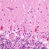 6A4 Hypoxia-Ischemia (Case 6) H&E 12