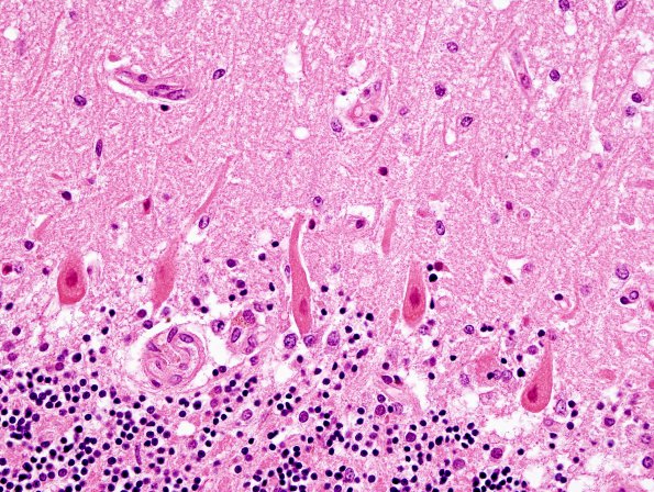 6A4 Hypoxia-Ischemia (Case 6) H&E 12