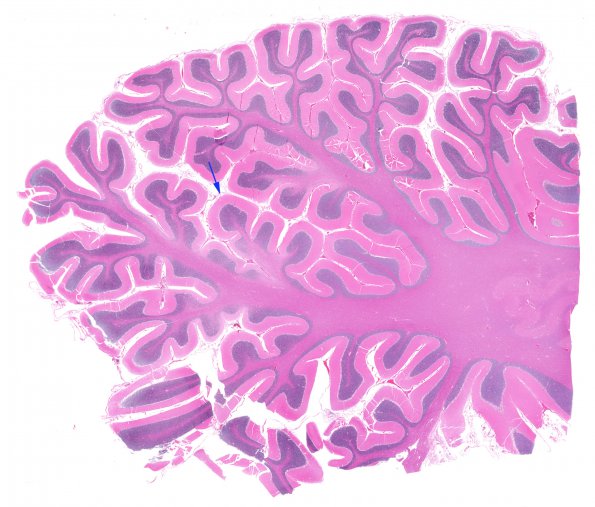 7A1 Hypoxia-Ischemia (Case 7) H&E whole mount copy