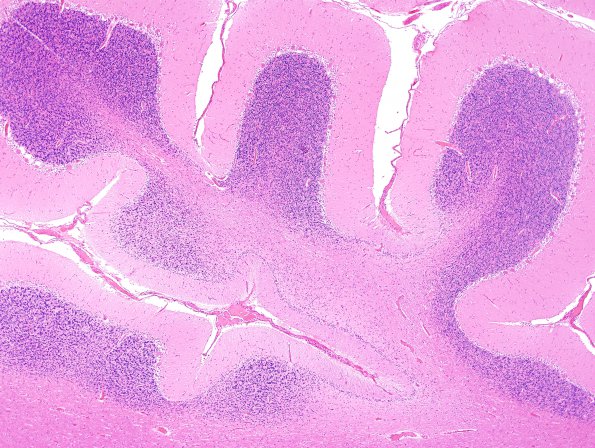 7A2 Hypoxia-Ischemia (Case 7) H&E 4