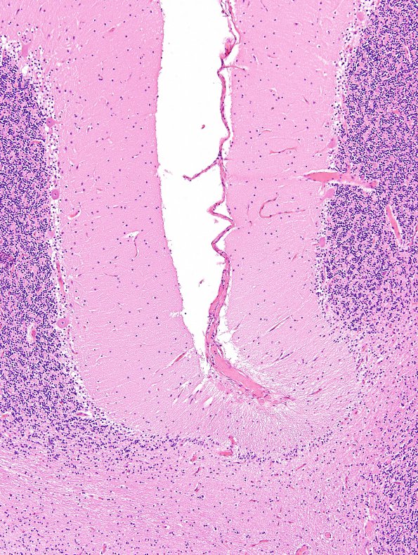 7A3 Hypoxia-Ischemia (Case 7) H&E 5