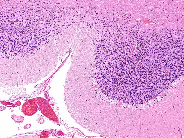 7A4 Hypoxia-Ischemia (Case 7) H&E 2