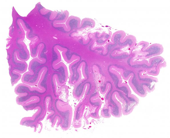 8A1 Hypoxia-Ischemia, adult (Case 8) N16 H&E WM 1A