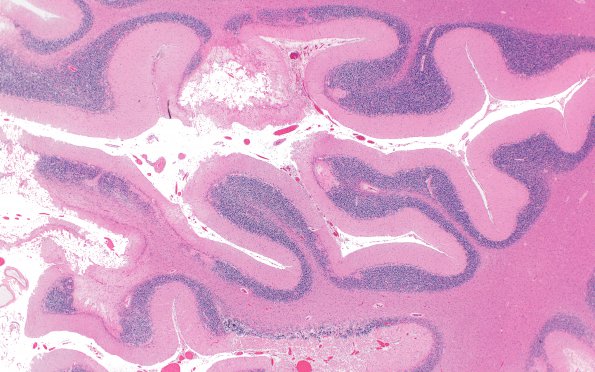 8A2 Hypoxia-Ischemia, adult (Case 8) N16 H&E 2XA