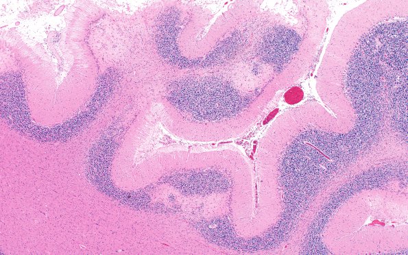 8A3 Hypoxia-Ischemia, adult (Case 8) N16 H&E 4X 2a