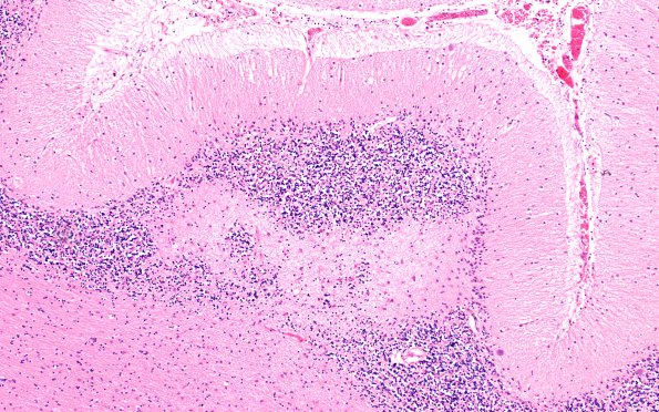 8A4 Hypoxia-Ischemia, adult (Case 8) N16