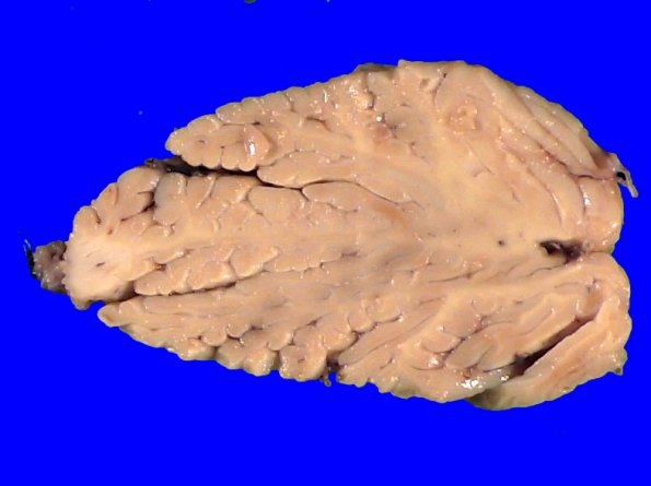 9A1 Hypoxia-ischemia, cerebellum, unusual (Case 9) _1