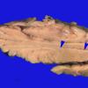 9A2 Hypoxia-ischemia, cerebellum, unusual (Case 9) _2 copy