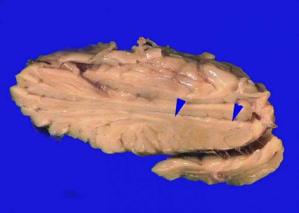 9A2 Hypoxia-ischemia, cerebellum, unusual (Case 9) _2 copy