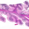 9B1 Hypoxia-ischemia, cerebellum, unusual (Case 9) N13 H&E WM copy