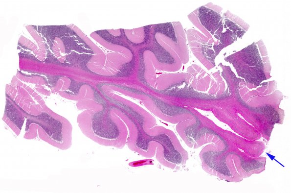 9B1 Hypoxia-ischemia, cerebellum, unusual (Case 9) N13 H&E WM copy