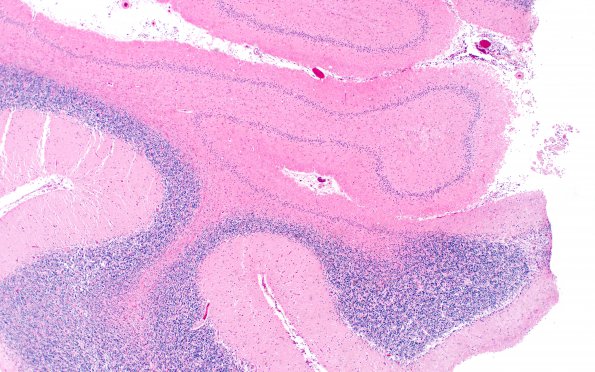 9B2 Hypoxia-ischemia, cerebellum, unusual (Case 9) N13 H&E 3