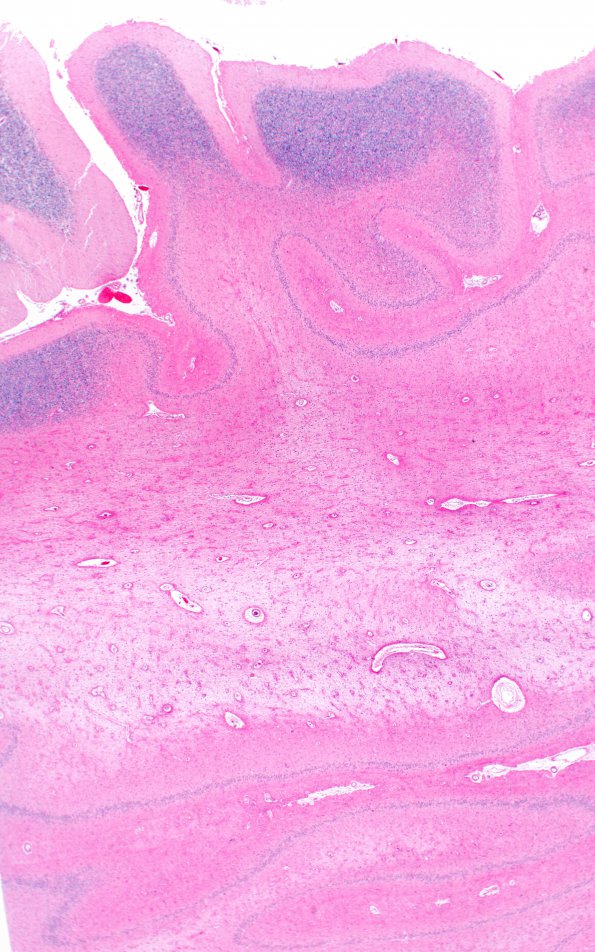 9B4 Hypoxia-ischemia, cerebellum, unusual (Case 9) N12 H&E 2X