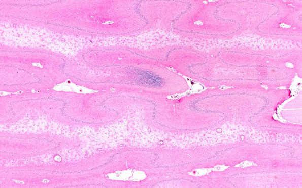 9B5 Hypoxia-ischemia, cerebellum, unusual (Case 9) N12 H&E 1