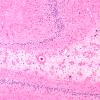 9B6 Hypoxia-ischemia, cerebellum, unusual (Case 9) N12 H&E 10X