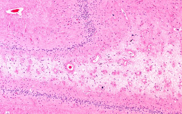 9B6 Hypoxia-ischemia, cerebellum, unusual (Case 9) N12 H&E 10X