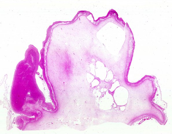 1B1 Hypoxia Ischemia (Persist Veg State, Case 1) N5