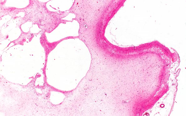 1B2 Hypoxia Ischemia (Persist Veg State, Case 1) N5 2X 2