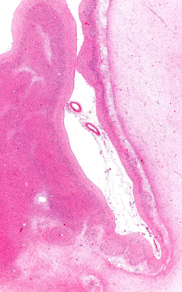 1B3 Hypoxia Ischemia (Persist Veg State, Case 1) N5 2X