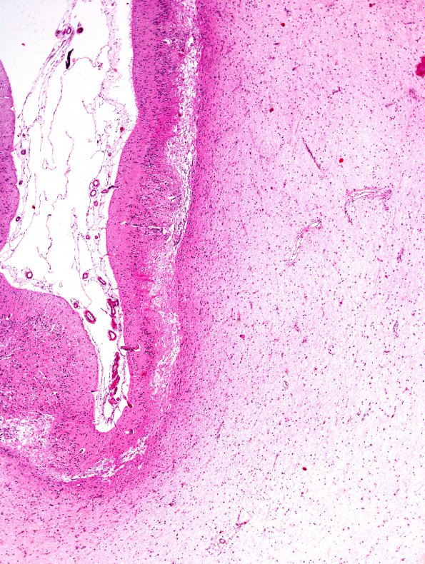 1B4 Hypoxia-Ischemia, OD 15 years vegetative (Case 1) N5 H&E 2