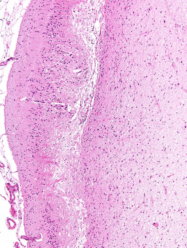 1B5 Hypoxia-Ischemia, OD 15 years vegetative (Case 1) N5 H&E 1