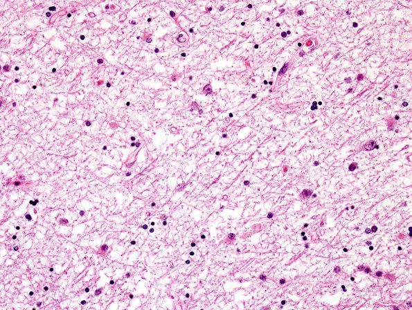 1B6 Hypoxia-Ischemia, OD 15 years vegetative (Case 1) N5 H&E 3