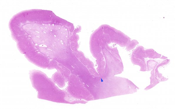 1C1 Hypoxia-Ischemia, SP Drug OD (Case 1) H&E N1 WM copy