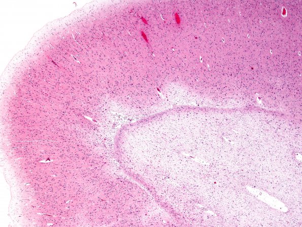 1C2 Hypoxia-Ischemia, OD 15 years vegetative (Case 1) N1 H&E 5